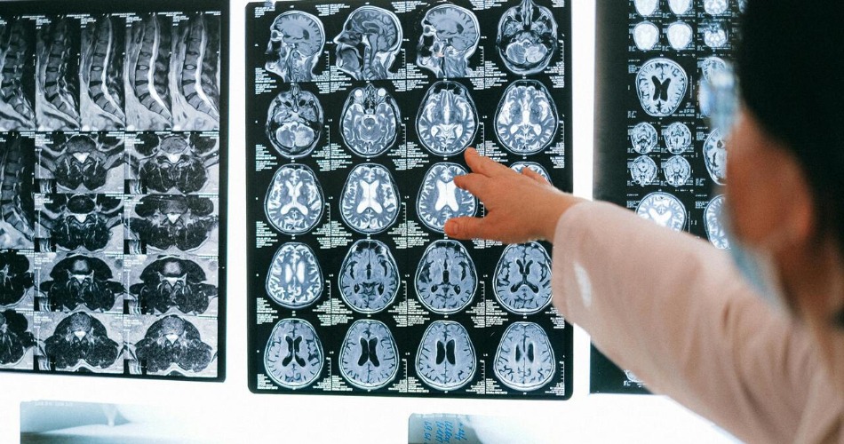 Fumar, un factor de riesgo para el ictus